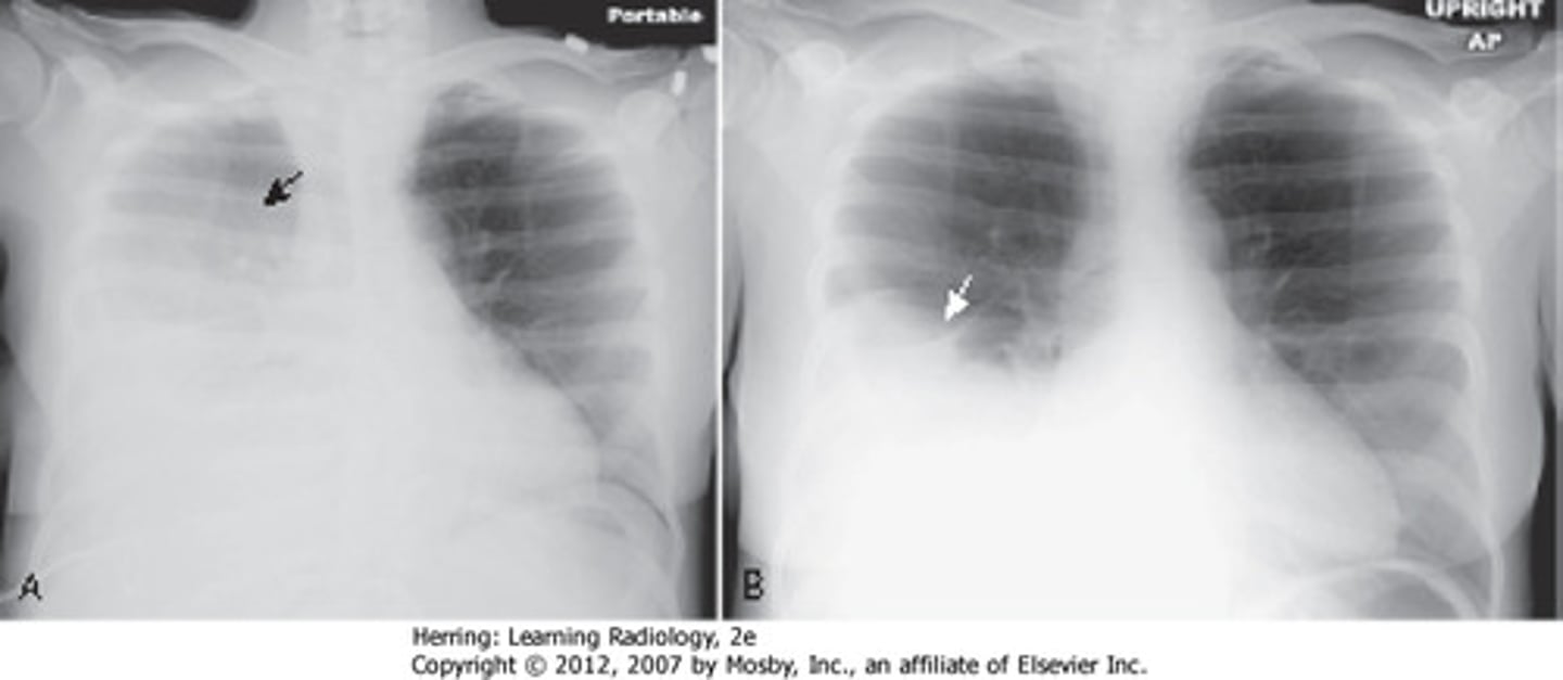 <p>trachea affected (pushed to opposite side), Damoiseau line</p>