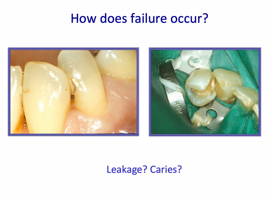 <ol><li><p>generally occur either due to <strong>fatigue or breaking</strong></p></li><li><p>more commonly, the <strong>leakage </strong>of the <strong>restoration margin</strong> </p></li></ol><p></p>