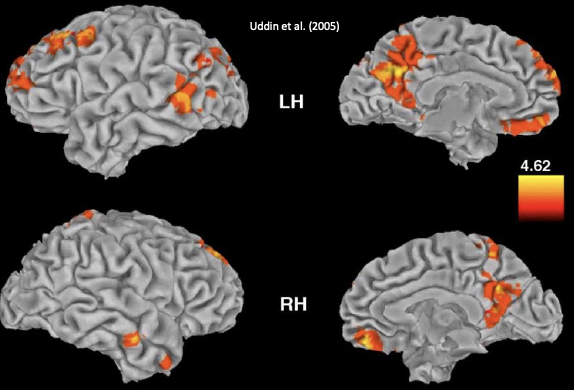 <ul><li><p>controlling stimulation via connections to frontal regions and networks </p></li><li><p><mark data-color="yellow" style="background-color: yellow; color: inherit;">default mode network (DMN):</mark> supports <span><u><span>self-other distinction</span></u></span>, which allows the brain to separate one’s own internal states from those of others during social cognition</p></li></ul><p></p>