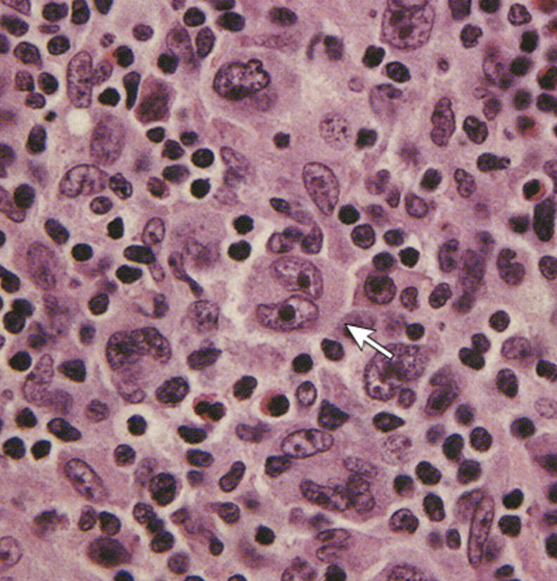 <p>A large abnormal lymphocyte that may contain more than 1 nucleus</p>