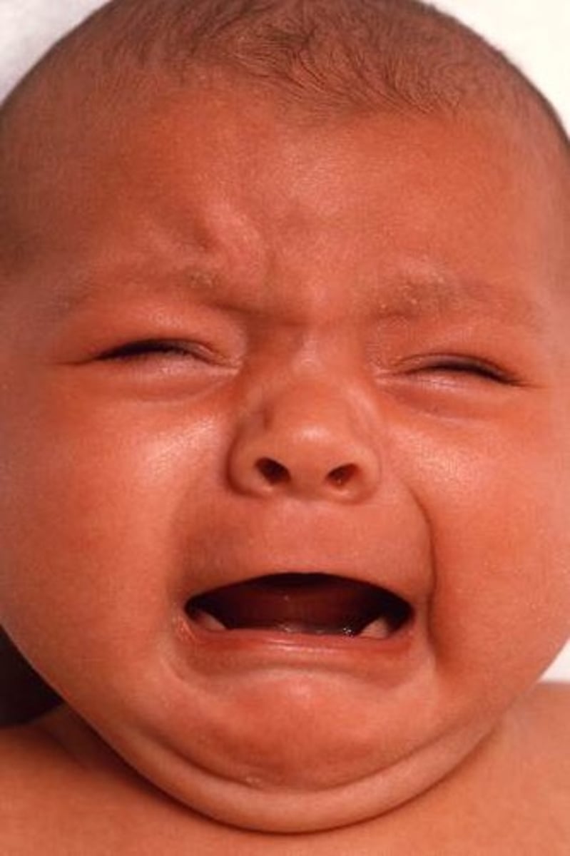 <p>Define Condition:</p><p>Loud crying for several hours (often late in day) + drawing up legs &amp; arching back</p><p>-Hx:</p><p>&gt; Self-limiting in early childhoood</p><p>&gt; 3 wks to 3 mo</p><p>&gt; Multifactorial</p><p>-Tx:</p><p>&gt; Release of Flatus</p><p>&gt; OMT at Occipital Condyles (remove pressure of CN X or Vagus)</p>