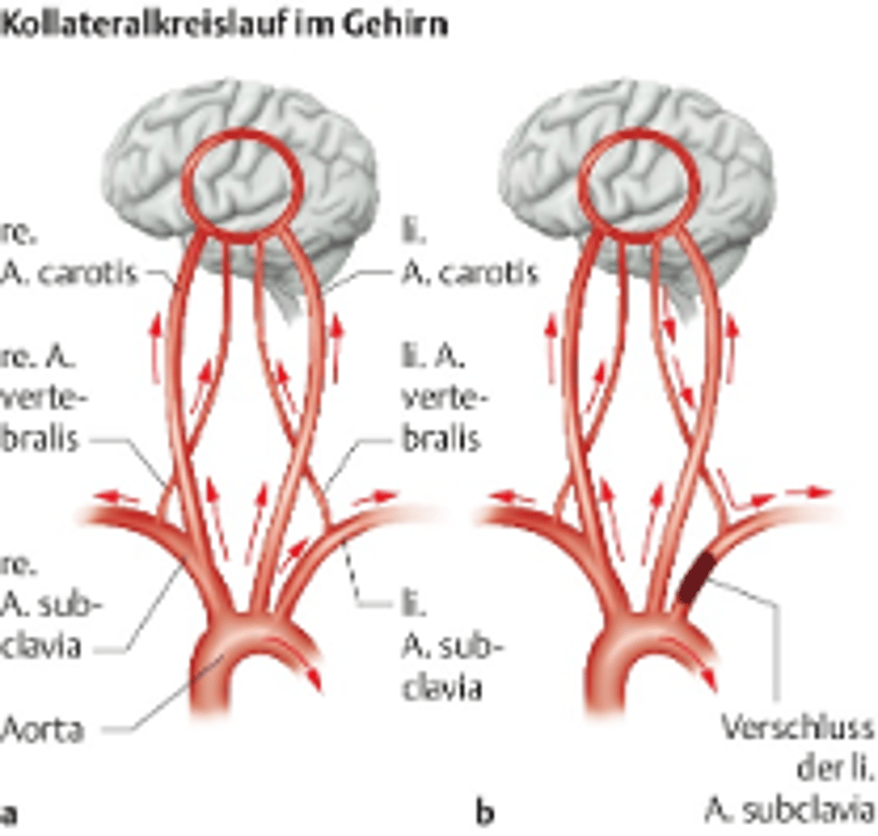 <p>occlusion or severe stenosis of the proximal subclavian artery leading to decreased flow of the ipsilateral vertebral artery</p>