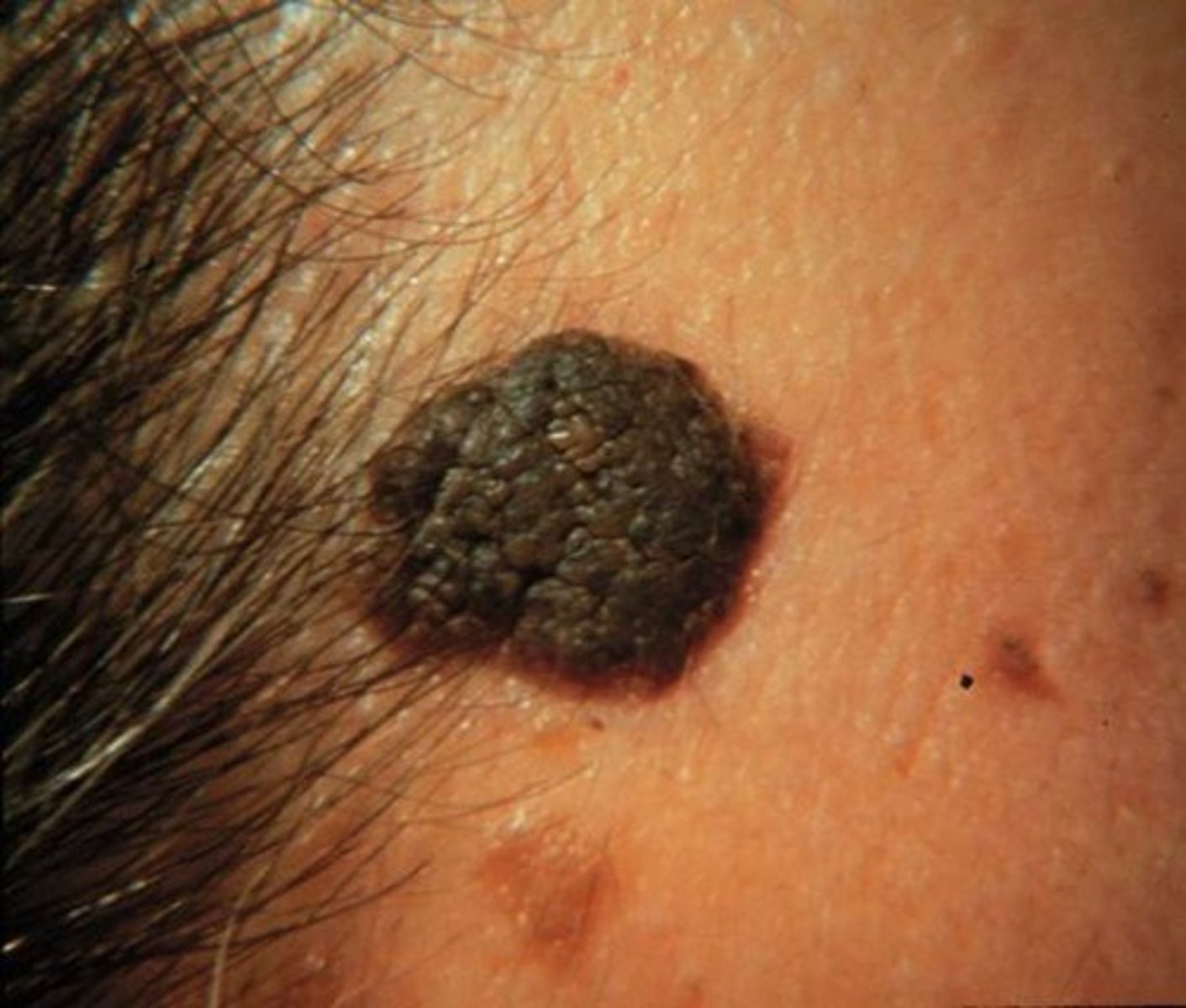 <p>treatment for which type of pigmented lesion:</p><p>• Rarely removed unless there are</p><p>esthetic concerns or they are</p><p>becoming irritated</p><p>• No malignant potential</p>