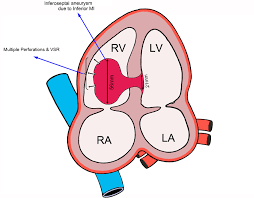 * Anterior → seperating septum 
* Posterior → seperating Aortic vestibule & Rt atrium 