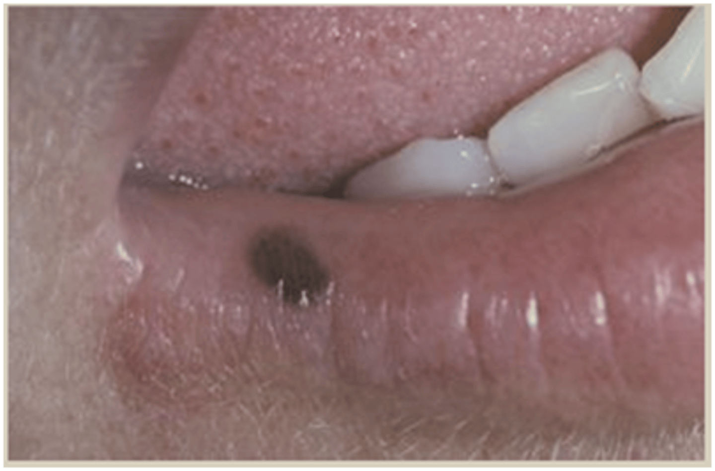 <p>oral melanotic macule</p>