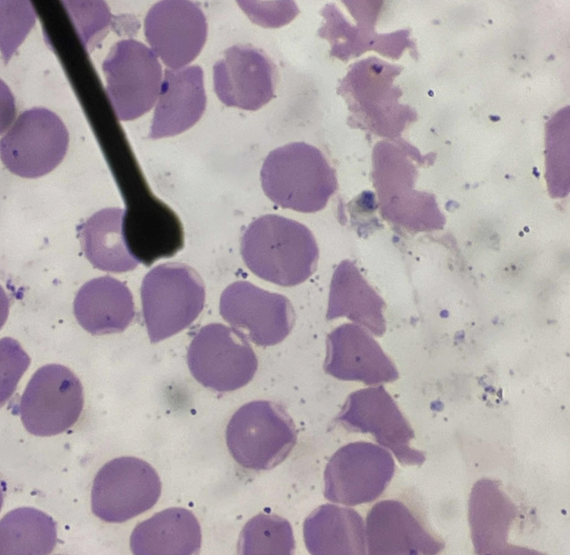 <p>A. Identify the pointed cell</p><p>B. Describe the striking feature</p><p>C. Associated with what condition ?</p><p>D. What rigid inclusion does this cell contain?</p>