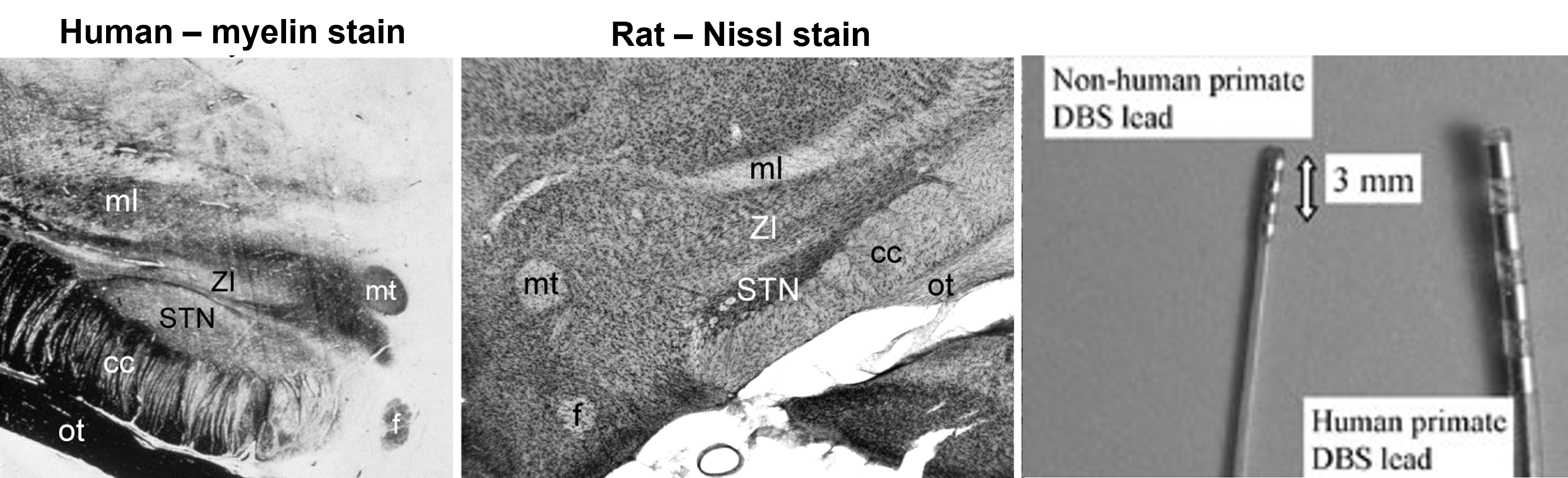 <p>chronically implanted electrodes targeting the STN to treat Parkinson’s disease will also stimulate the zona incerta</p>