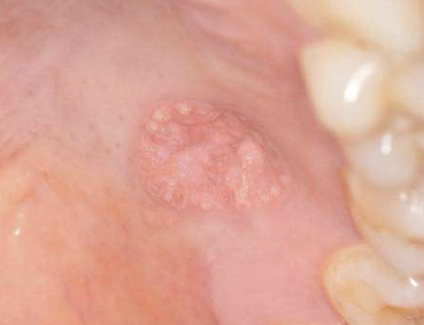 <ol><li><p>50% of oral lesions on gingiva/alveolar mucosa </p></li><li><p>may be pink, white, red, yellow, orange </p></li><li><p>well-demarcated verrucous mass </p></li><li><p>may resemble squamous papillomas or early carcinomas </p></li></ol><p></p>