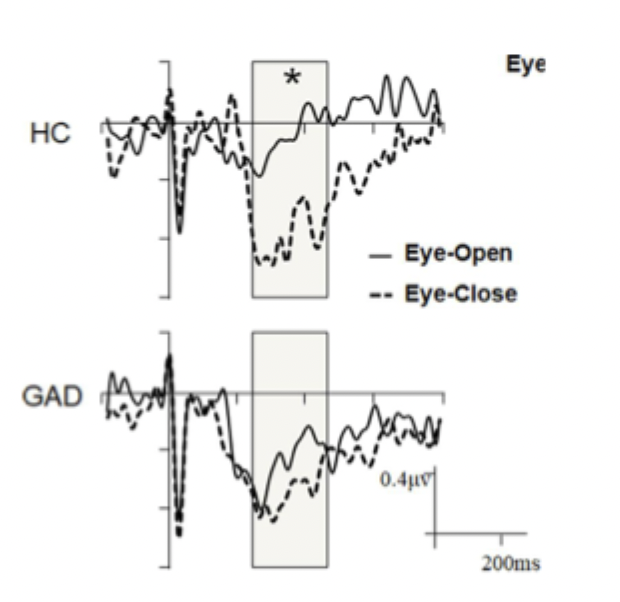 <ul><li><p>in healthy controls, heartbeat-evoked potentials were greater in eyes closed compared to eyes open at rest</p></li><li><p>greater focus in interoception with eyes closed</p></li><li><p>In GAD there was no difference between conditions</p></li><li><p>higher monitoring of interoception with eyes open - hypervigilance</p></li><li><p>cortical response to heartbeats greater in GAD</p></li></ul><p></p>