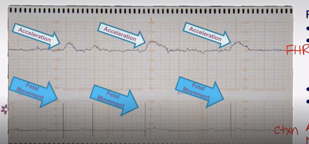 <p>Top = Fetal HR</p><p>Bottom = Uterine Contractions</p>