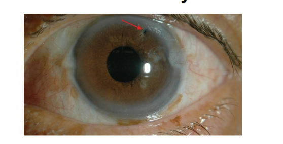 <p>iridectomy&nbsp;</p>