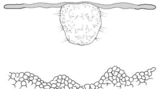 <p>Elevación de la piel, bien delimitado, sólido</p><p>Por infecciones bacterianas y hongos, granulomas o tumores</p>