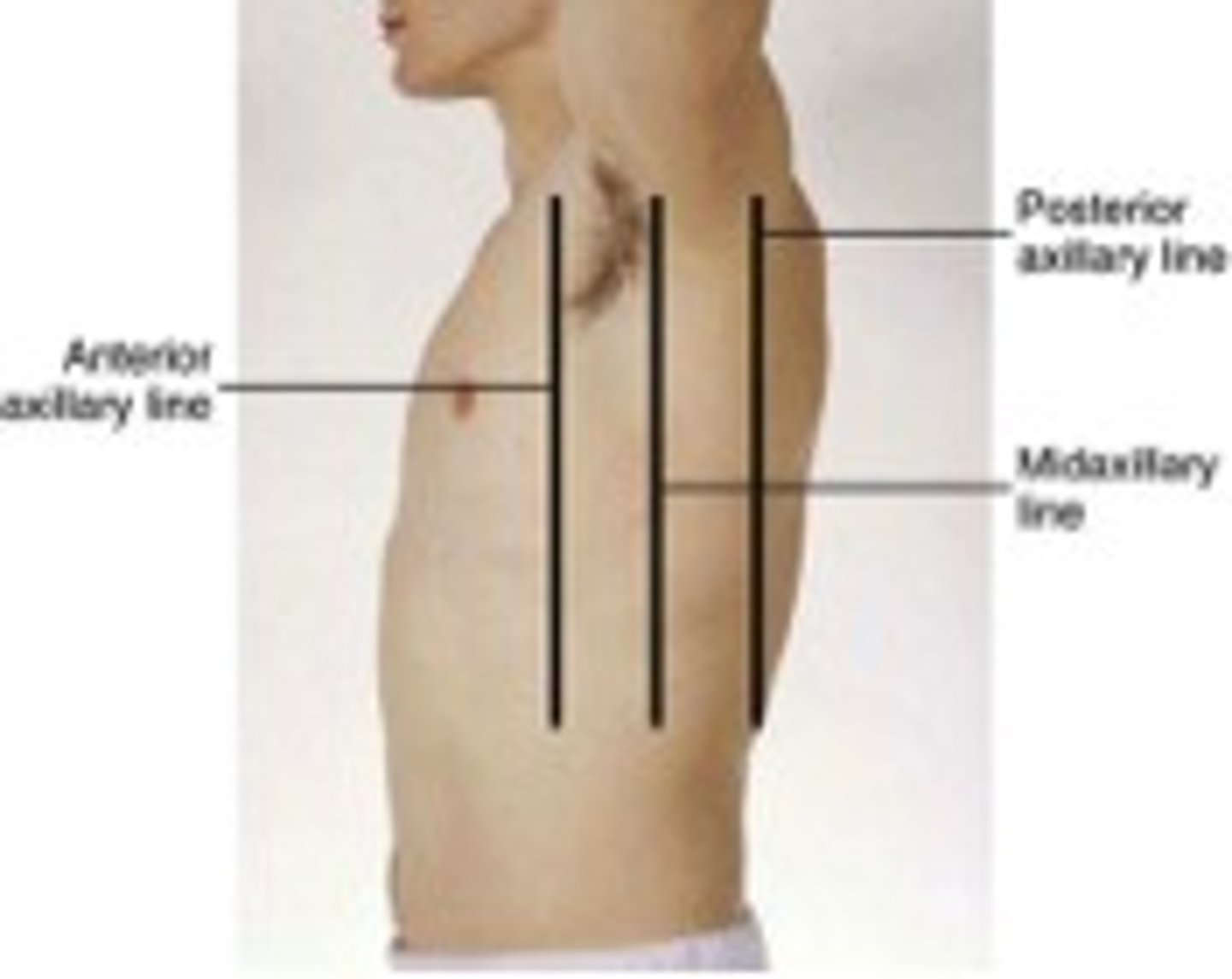 <p>a line that is parallel to the mid-axillary line and passes through the posterior axillary skinfold</p>