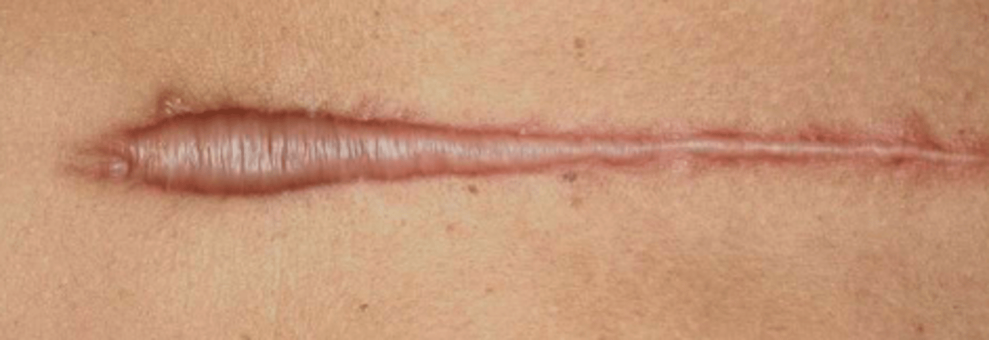 <p>- excessive haphazard collagen deposition with reduced cross linking (reduced skin strength) and changes in granulation tissue and ground substance</p><p>- develops within 1-3 months post-injury, progresses for 3-6 months, gradually regresses over time</p>