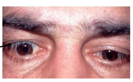 <ol><li><p>Von grafe sign - lid lag on inferior gaze </p></li></ol><p></p>