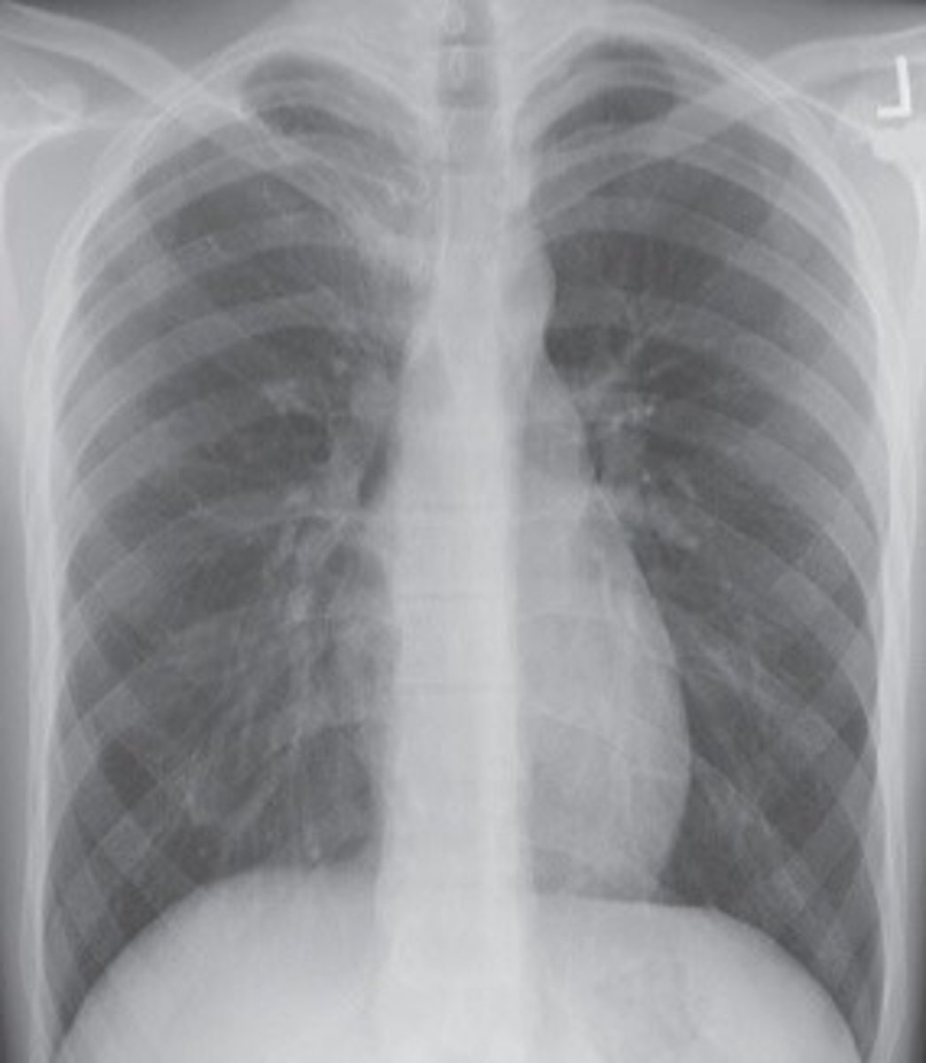 <p>long and narrow lungs, 10% of the population</p>