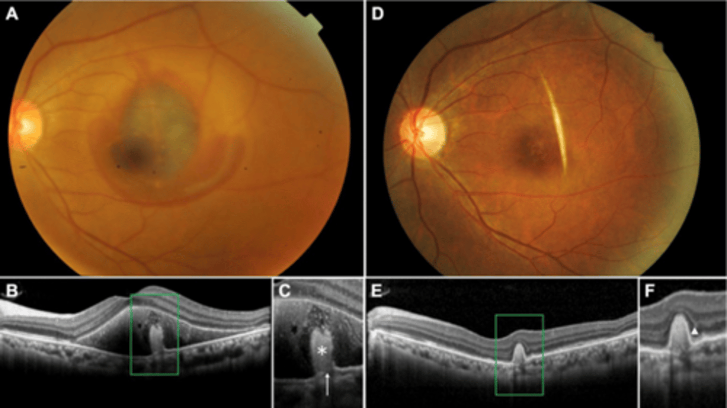 <p>RPE disruption</p><p>+/- hemorrhage</p>