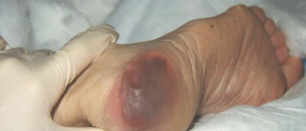 <ul><li><p>Reveal the actual extent of tissue injury OR may resolve w/o tissue loss.</p></li><li><p>Necrotic Tissue = Subcutaneous Tissue, Granulation Tissue, Fascia, Muscle, or Other Underlying Structures are visible </p><ul><li><p>Indicates FULL thickness tear (Unstageable, Stage 3 or Stage 4)</p></li></ul></li></ul><p></p>