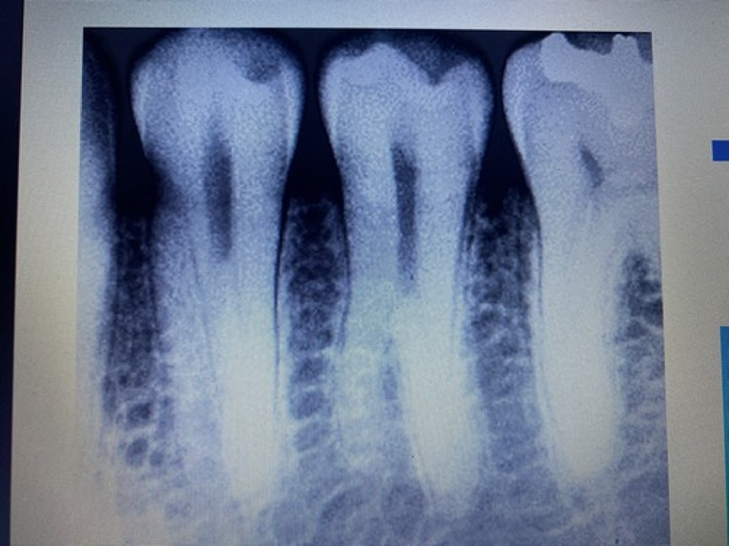 <p>Supernumerary roots</p>
