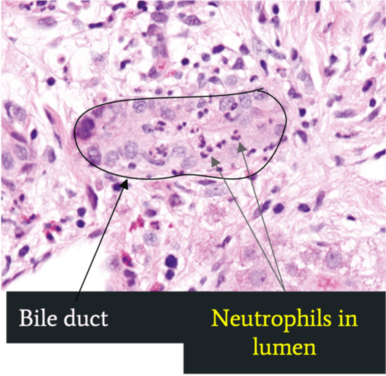 <p>Define Cholelithiasis Complication:</p><p>Infection of bile ducts d/t obstruction leading to stasis/bacterial overgrowth</p><p>-Path: Stone blocks flow of bile --&gt; GI bacteria able to ascend biliary tree</p><p>-Sx/PE: </p><p>&gt; Charcot Triad</p><p>&gt;&gt; Jaundice</p><p>&gt;&gt; Fever</p><p>&gt;&gt; Abd Pain</p><p>&gt; Reynolds Pentad (SEPTIC!)</p><p>&gt;&gt; Jaundice</p><p>&gt;&gt; Fever</p><p>&gt;&gt; Abd Pain</p><p>&gt;&gt; AMS</p><p>&gt;&gt; Shock (Hypotension)</p><p>-Dx:</p><p>&gt; Labs:</p><p>&gt;&gt; Increased WNC</p><p>&gt;&gt; Cholestasis = Increased ALP = Increased AST/ALT</p><p>&gt;&gt; Increased Tbili &amp; CB</p><p>&gt;&gt; Gram (-): E. coli, Klebsiella, Enterobacter</p><p>&gt; Biopsy: Neutrophils in bile duct lumen</p><p>-Tx:</p><p>&gt; Abx</p><p>&gt; Biliary Drainage</p>