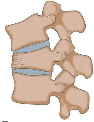 <p>a type of fracture where the bone is crushed or collapses, often due to compressive forces</p>