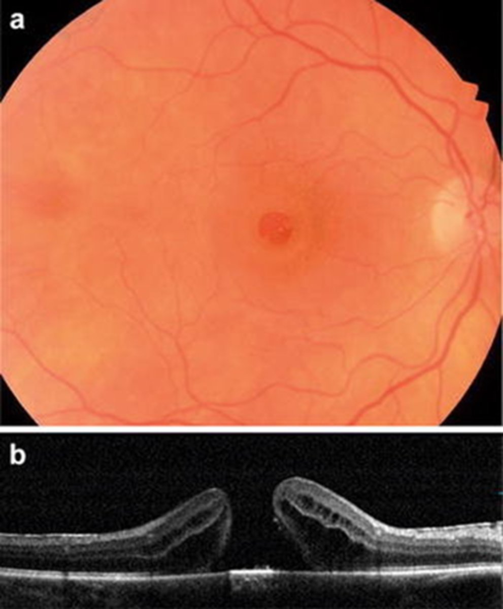 <p>refer to retina for...</p><p>1. intravitreal injection of gas = expansile gas bubble requires face down position, &lt;2500ft elevation for short period</p><p>2. pars plana vitrectomy w/ gas tamponade +/- ILM peel</p>