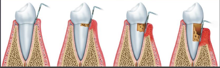 <p>How does one get periodontal disease?</p>