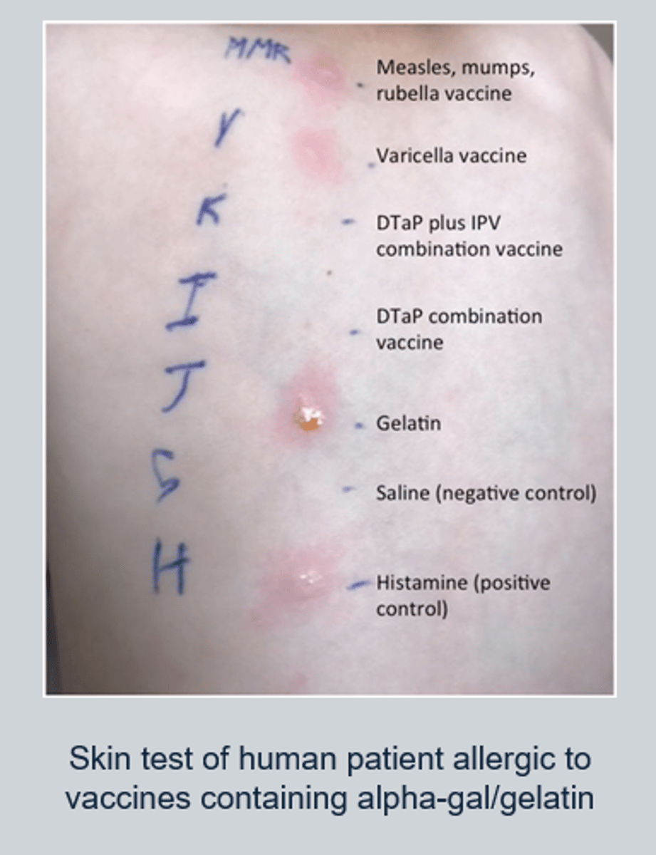 <p>Ig-E mediated allergic response when antigen molecule encountered--> degranulation of mast cells and release of histamine = anaphylactic shock within a few minutes to an hour</p><p>When a person is first exposed to a component of the vaccine (e.g., a protein, preservative, or other substances), their immune system may mistakenly recognize it as harmful.</p><p>The immune system responds by producing IgE antibodies against that specific component (this is called sensitization).</p><p>IgE antibodies bind to mast cells and basophils, which are immune cells involved in allergic responses.</p><p>On subsequent exposure to the same vaccine (or components of it), the IgE antibodies on mast cells and basophils recognize the allergen (vaccine component) and become activated.</p><p>This activation triggers the release of inflammatory mediators, including histamine, prostaglandins, and leukotrienes, from the mast cells.</p>