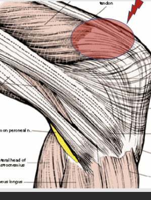 <p>anterior compartment</p>