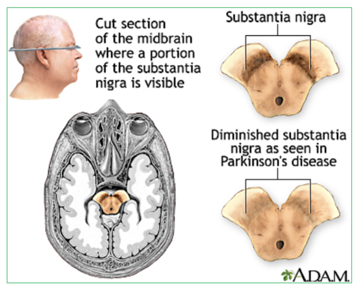 <p>Degeneration of neurons that secrete neurotransmitter Dopamine will result in <strong>Parkinson’s disease. </strong></p><p><strong>→ </strong>This leads to <strong>motor control issues</strong> such as tremors, stiffness, and difficulty with balance and coordination. </p>
