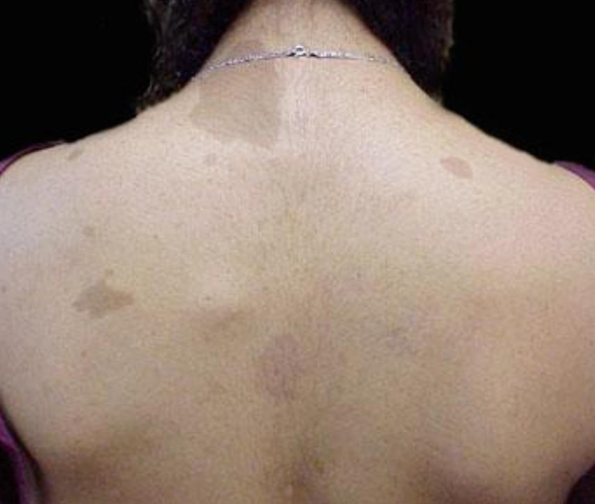 <p>What is Neurofibromatosis 1 (NF1)?</p>