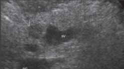 <p>The patient presented with a palpable mass in the RUQ and an US was ordered. What can be assumed here?</p>