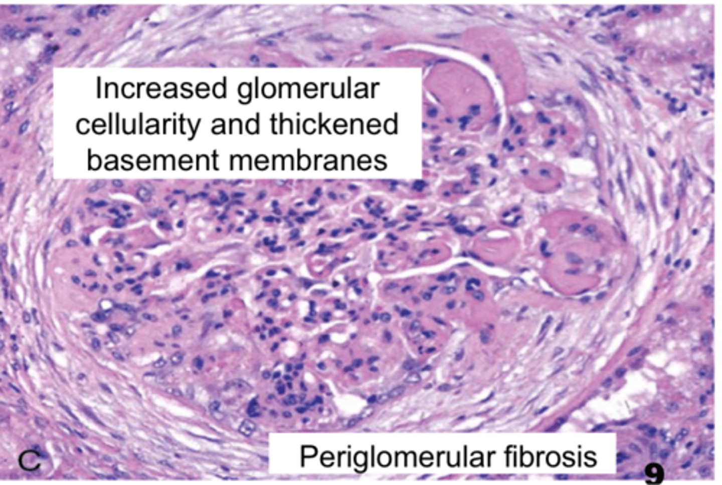 <p>Increased glomerular cellularity with thickened basement membranes</p><p>Periglomerular fibrosis</p>