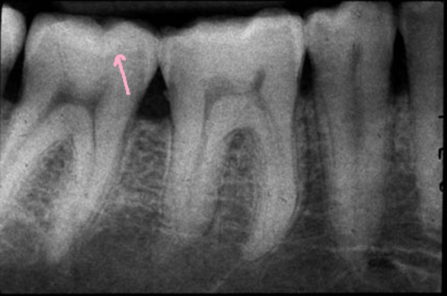<p>Line marking the junction of the dentin and the enamel.</p>