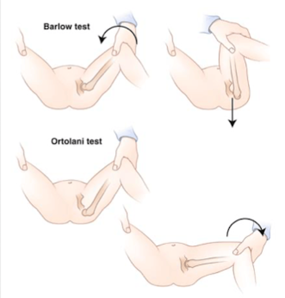 <p>With the hips abducted, gentle apply pressure to the posterior hip.</p><p>A positive indicating possible DDH is noted by a clunk or jerk with this maneuver.</p>