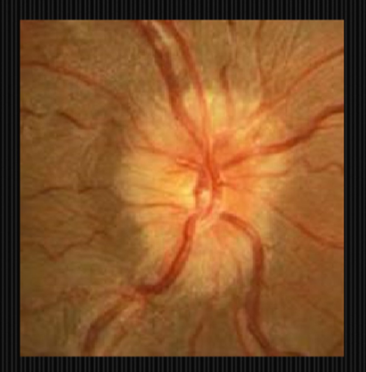 <p>GCA (older pt)</p><p>optic neuritis (younger pt)</p><p>classic migraine prodrome (younger pt, w/ flashing lights, nausea, emesis, head pain)</p>