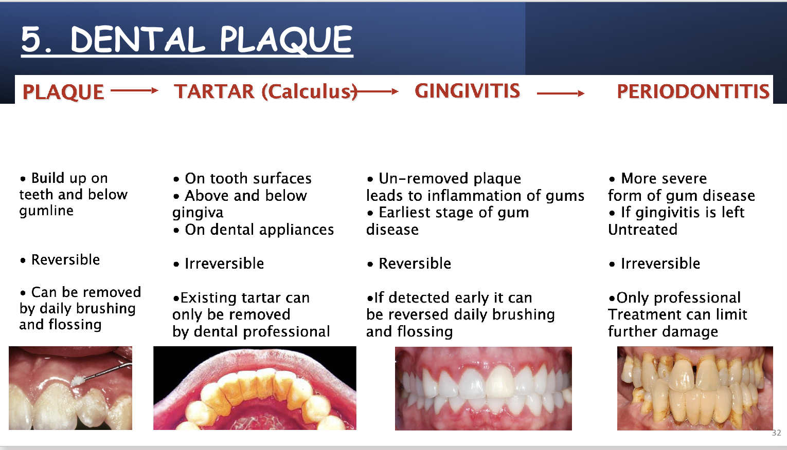 <p>Accumulation of different species of bacteria, that form dental plaque. naturally acquired bacterial biofilm which develops on teeth. <span style="font-size: calc(var(--scale-factor)*27.80px);"><span>some bacterial species may be in greater relevance in the</span></span><br><span style="font-size: calc(var(--scale-factor)*27.80px);"><span>development of caries and periodontal diseases.</span></span></p><p><span style="font-size: calc(var(--scale-factor)*27.80px);"><span>Biofilm is known as plaque, and is defined as </span></span><span><span>a set of microorganisms firmly adhered to each other and to a surface, embedded, intermixed and surrounded by an extracellular matrix of triple origin: bacterial origin, saliva and diet.<br>• In the dental biofilm,<br>o microorganisms represent around 15-20% of its volume<br>o and the matrix the 75-80%</span></span></p>