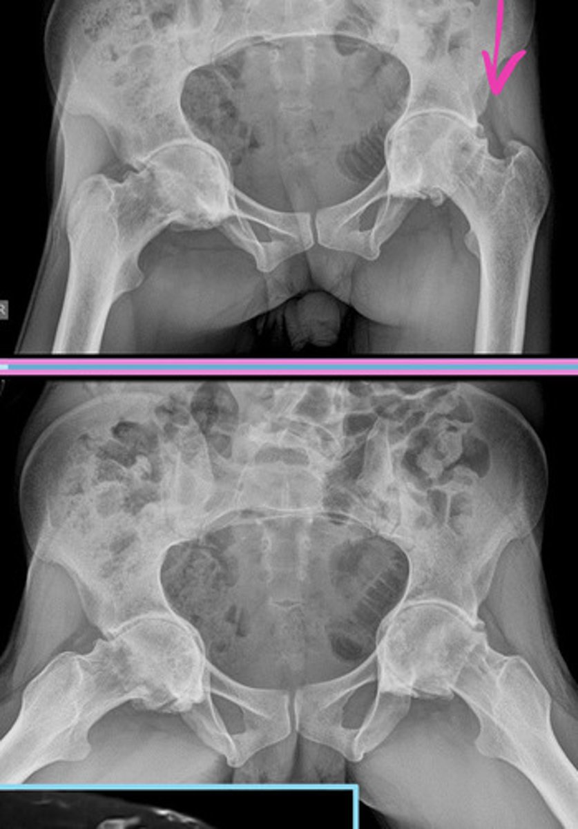 <p>— Cam or Pincer morphology</p><p>— Pistol grip deformity (Cam)</p><p>— Acetabular overcoverage (Pincer)</p><p>— Ilioischial line violation (protrusio acetabuli)</p>