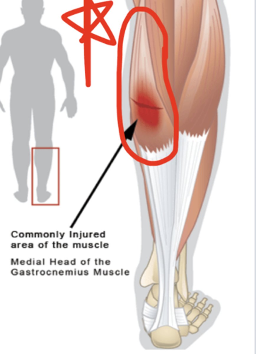 <p>Gastrocnemius tear</p>