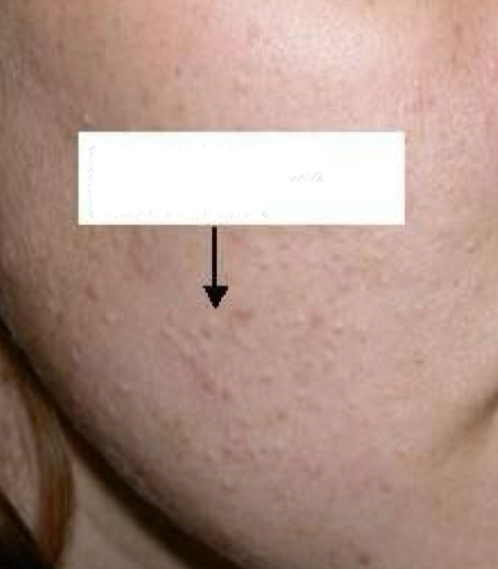 <p>what type of lesion and condition is depicted</p>