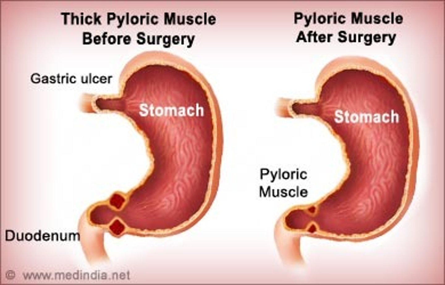 <p>pyloromyotomy</p>