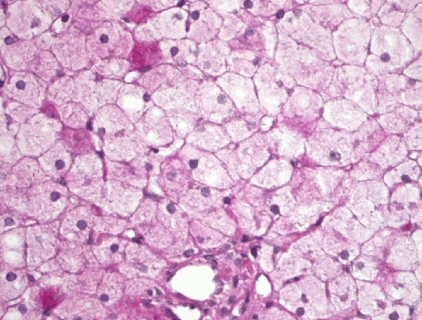 <p>- Vacuoles in swollen hepatocytes with indistinct borders, "fluffy" or "lacy" cytoplasm (not sharp borders)</p>
