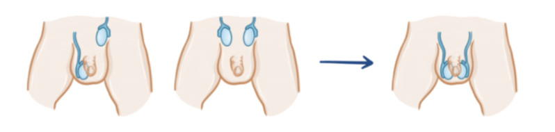 <p>what is cryptorchidism?</p>