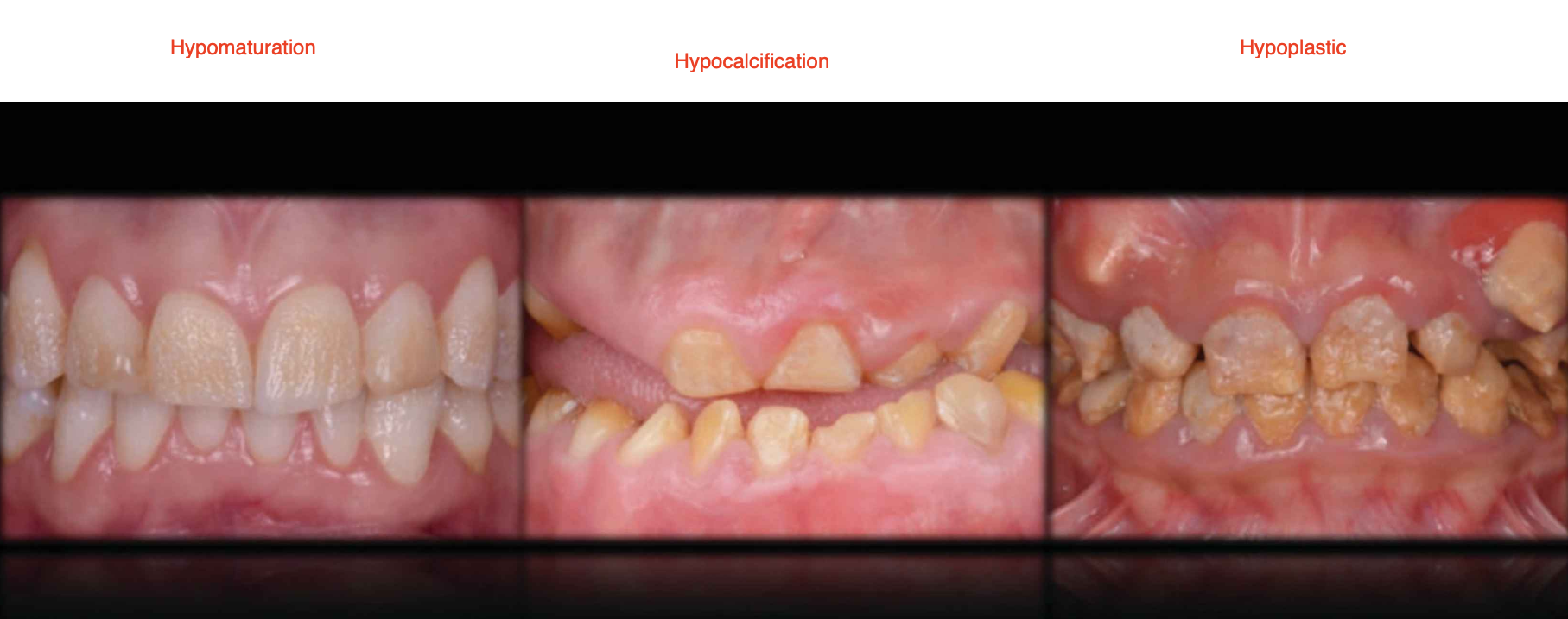 <ul><li><p><strong>Cause:</strong> Mutations in <strong>AMELX, ENAM, MMP20, and FAM83H</strong> genes</p></li></ul><p><strong>Types:</strong></p><ol><li><p><strong>Hypomaturation:</strong> Defect in the <strong>final growth and development</strong> of the tooth enamel (chips)</p></li><li><p><strong>Hypocalcification:</strong> Defect in the <strong>initial stage of enamel formation</strong>, followed by defective tooth growth (soft)</p></li><li><p><strong>Hypoplastic:</strong> Defects in the <strong>amount of enamel thin</strong></p></li></ol><p></p><ul><li><p>can be treated with flouride (must be ingested)</p></li></ul><p></p>