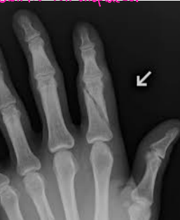 <p>What bone is fractured here? </p>