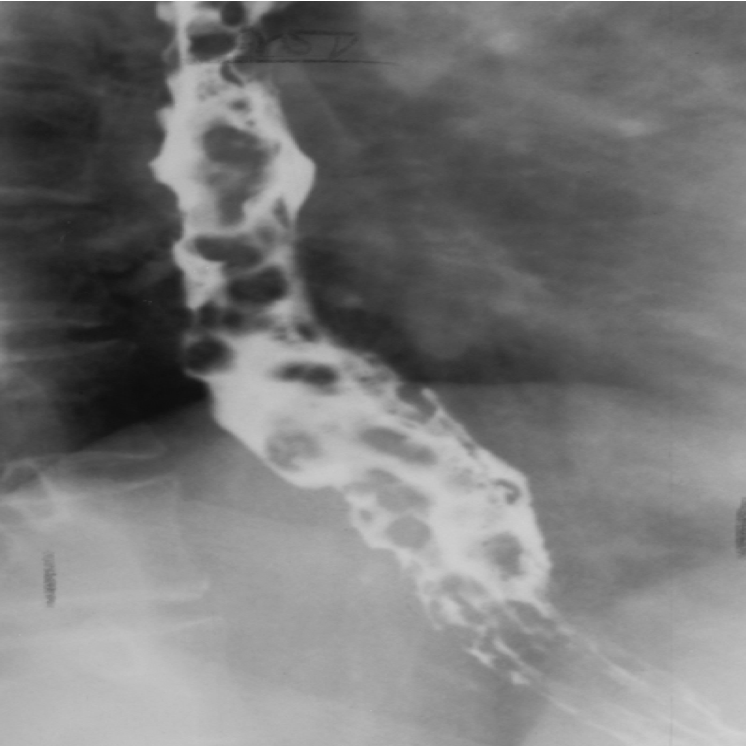 <p>Dilated veins in the wall of the esophagus can be a result of cirrhosis of the liver</p><p>Seen on xray- round or oval filling defects</p>