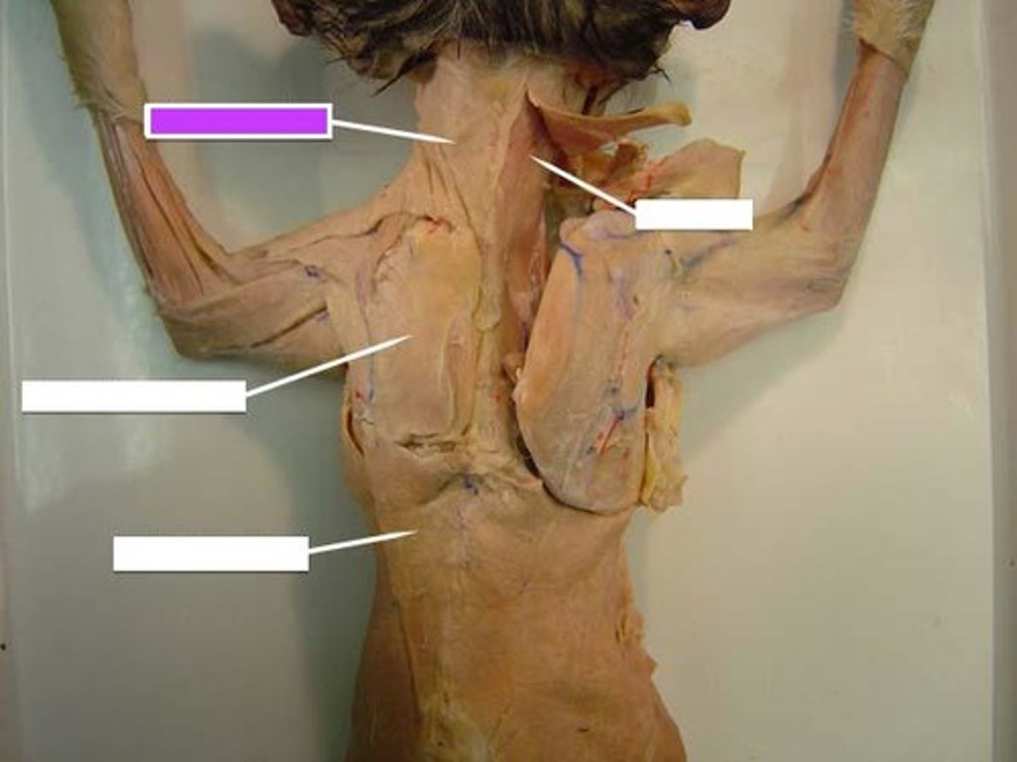 <p>Origin: Occipital bone and spines of cervical and thoracic vertebrae</p><p>Insertion: Clavicle, acrominon and spine of scapula</p><p>Action: Elevates, depresses, and aducts scapula; hyperextends neck.</p>