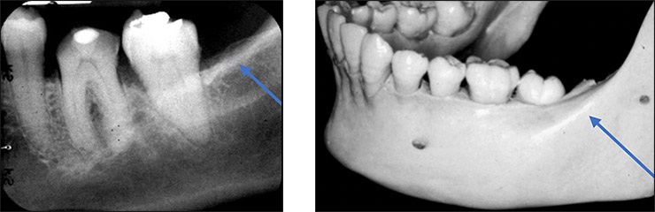 <ul><li><p>Radiopaque </p></li><li><p>Ex. External Oblique Ridge </p></li></ul><p></p>