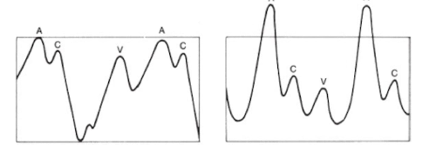 <p>Seen in ventricular tachycardia</p><p>-occurs when atria contract against closed mitral/ tricuspid valves</p>