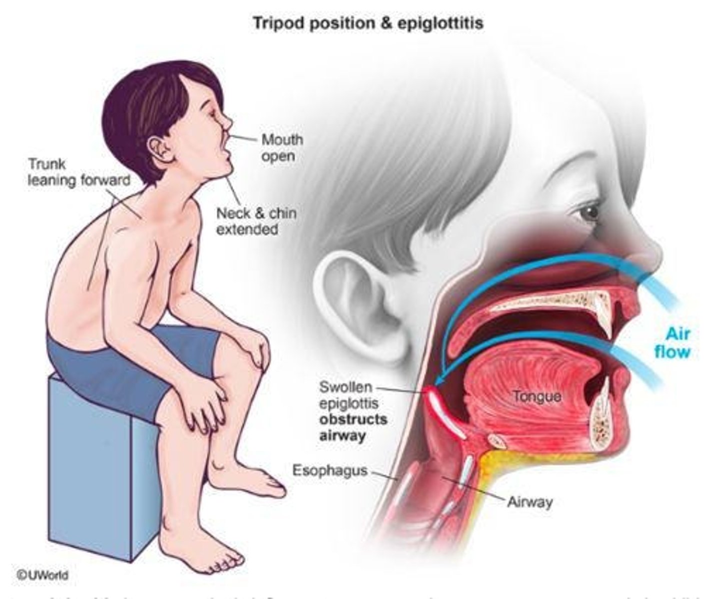 <p>a sitting position where the person leans forward, supports themselves with their hands on their knees or on a surface like a chair or table</p>